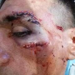 Paolo Tiralongo abandona la Vuelta con 40 puntos de sutura