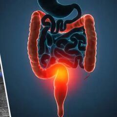 Cáncer de colón: qué es, síntomas y cómo identificarlo a tiempo
