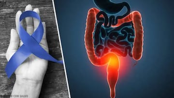 Cáncer de colón: qué es, síntomas y cómo identificarlo a tiempo