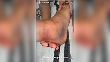 Ceballos muestra su tobillo dañado