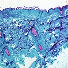 How does monkeypox spread and what are the differences with covid-19?