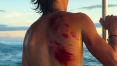 El surfista Max Beach con heridas en la espalda en las Fiji.