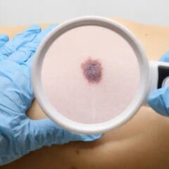 Síntomas del cáncer de piel: cómo prevenirlo