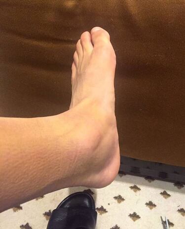 Alexis muestra la hinchazón en el tobillo después del triunfo