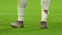 Así quedó la pierna de Mbappé tras la entrada de Tah