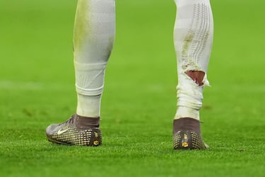 This is what Mbappé’s leg looked like after Tah’s challenge