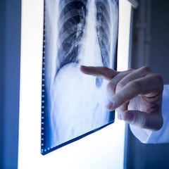 Descubren que un ingrediente común contra la tos puede ser la clave para combatir una enfermedad grave de pulmón