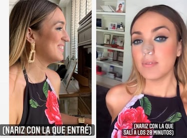 Marta Riesco muestra el antes y el después de su operación de nariz