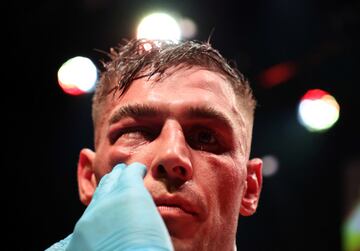 El BKB (Bare-knuckle boxing) es el deporte del boxeo sin el uso de guantes de boxeo u otro acolchado en las manos de los participantes.