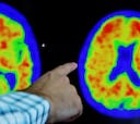 Un hombre explica el drama de ser diagnosticado de Alzheimer a los 41 años: “Una niebla se apodera de tu cerebro”