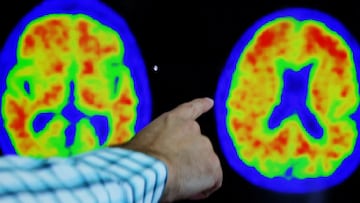 FILE PHOTO: A doctor points out evidence of Alzheimer’s disease on PET scans at the Center for Alzheimer Research and Treatment (CART) at Brigham And Women’s Hospital in Boston, Massachusetts, U.S., March 30, 2023.  REUTERS/Brian Snyder/File Photo