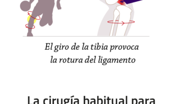 ¿Por qué se rompe el ligamento cruzado? Este gráfico lo explica