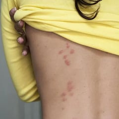 ¿Cómo evitar las picaduras de mosquitos, chinches y garrapatas en verano?