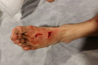 Champions: Así quedo el pie de Herrera: 17 puntos de sutura