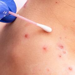 ¿Qué tan peligrosa es la viruela del mono? Principales síntomas