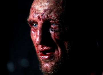 El BKB (Bare-knuckle boxing) es el deporte del boxeo sin el uso de guantes de boxeo u otro acolchado en las manos de los participantes.