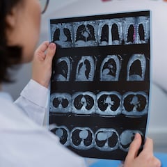 Diagnostican a una mujer de 72 años cáncer de próstata, le horroriza leer los resultados y acude al médico inmediatamente