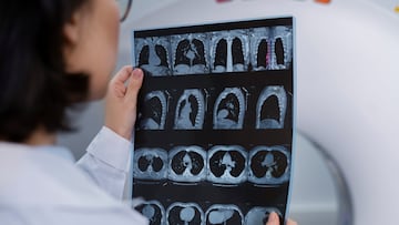 The medical report indicated this type of cancer, but it was all due to human error. The patient will not take legal action against the hospital.