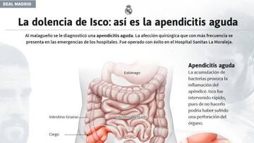 La dolencia de Isco: el gráfico sobre la apendicitis aguda