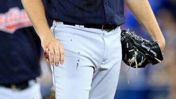 TORONTO, ON - OCTOBER 17: A detailed view of the bloody pinky finger of Trevor Bauer #47 of the Cleveland Indians in the first inning against the Toronto Blue Jays during game three of the American League Championship Series at Rogers Centre on October 17, 2016 in Toronto, Canada. Vaughn Ridley/Getty Images/AFP
== FOR NEWSPAPERS, INTERNET, TELCOS & TELEVISION USE ONLY ==