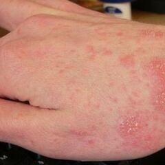 La COVID dispara la sarna: "He visto más casos ahora que en 20 años"