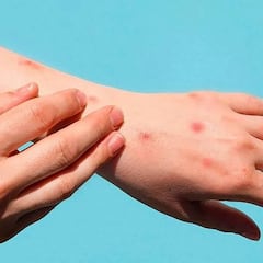 Viruela del Mono en México: En qué estados se reportan contagios y medidas