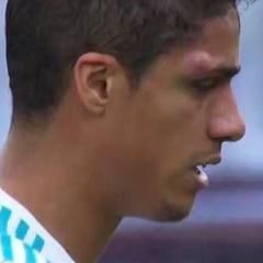 Varane se fue en el minuto 26 porque no veía bien la pelota
