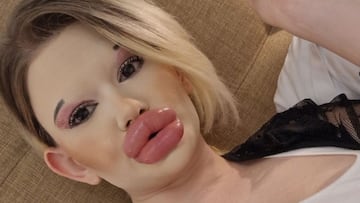 30 inyecciones en los labios para convertirse en la ‘Barbie’ humana