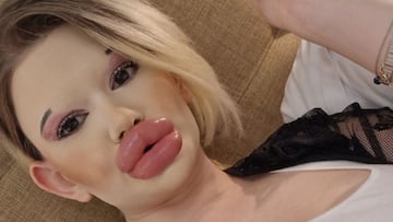 30 inyecciones en los labios para convertirse en la ‘Barbie’ humana