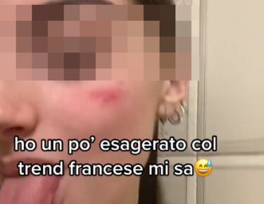 Preocupaci¨®n en Italia por la ¡®cicatriz francesa¡¯, la ¨²ltima moda de TikTok