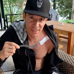 A Rigoberto Urán le retiran una placa de la clavícula