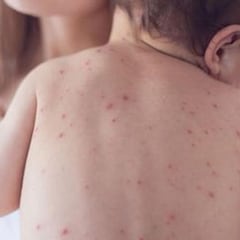 Las muertes por sarampión aumentan un 50% en cuatro años