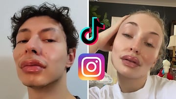 Cómo activar el filtro Botox Pillow Face en TikTok e Instagram de cirugía estética