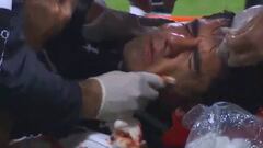 Barroso se fue en ambulancia tras sufrir fractura nasal