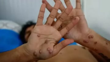 Minsal decreta alerta sanitaria por viruela del mono en Chile: qué es, restricciones y cuantos casos hay hasta hoy