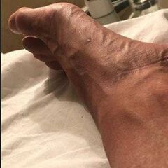 Así quedó el tobillo de Janko Tipsarevic tras un entrenamiento