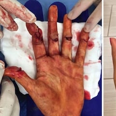 El milagro de Kvitova: así estaba su mano hace 9 meses