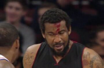 Stoudemire (Miami), con la frente ensangrentada.