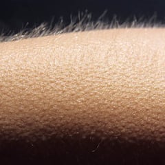 ¿Por qué se pone la piel de gallina, qué significa y cuándo sucede?