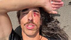 La cara del skater Danny Le&oacute;n, con el brazo en la frente y los ojos cerrados, uno de ellos ensangrentado, tirado en la playa de Bali tras sufrir un accidente con su tabla de surf en septiembre del 2022. 