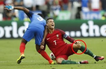 Esguince de la rodilla izquierda.