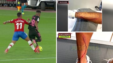 Así quedó la pierna de Marvin tras el entradón de Machís que no fue ni amarilla