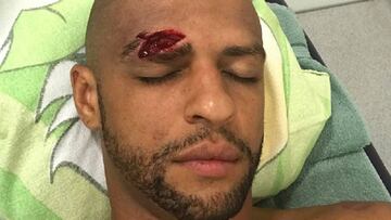 Así quedó la ceja de Felipe Melo.