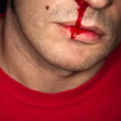 Alerta si tienes este tipo de sangrado de nariz