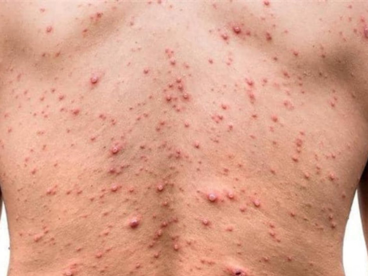 Aumentan casos de sarampión en México: Hay riesgo de perder certificado ante la OMS - AS México