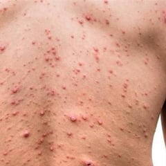 Aumentan casos de sarampión en México: Hay riesgo de perder certificado ante la OMS