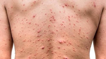 México registra 7 mil 131 casos de sarampión y Chihuahua es el estado con más contagios.