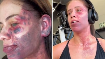 Una joven muestra el resultado de un tratamiento láser para quitarse esta marca de nacimiento