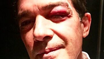 Antonio Banderas con un ojo morado en el rodaje de "Stoic". Foto: Instagram