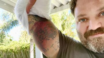 El skater Bam Margera mostrando su brazo escayolado por una ca&iacute;da en skate a c&aacute;mara. 